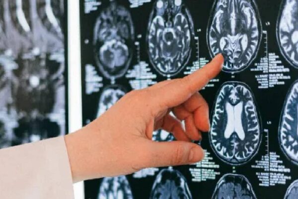 doctors found Killing Zombie Cells lead to Reversing Covid Induced Brain Aging